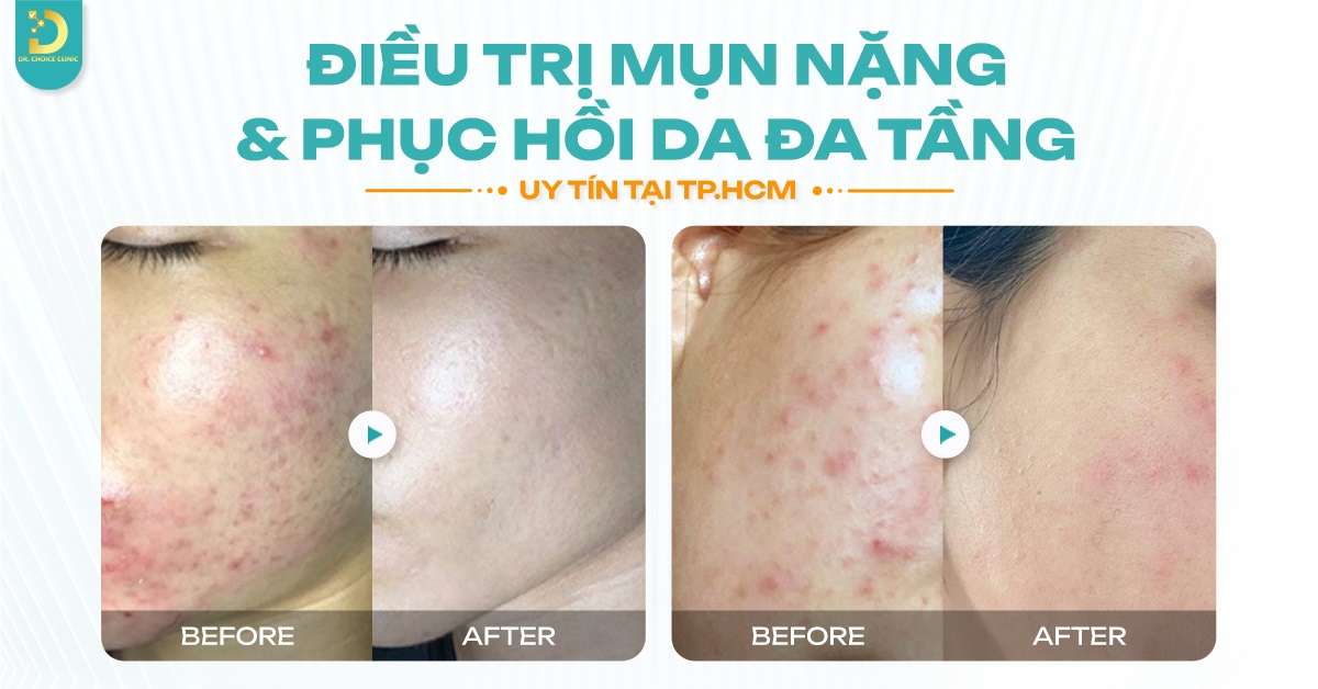 Mụn Ở Tuổi Dậy Thì: Đặc Điểm, Nguyên Nhân Và Cách Điều Trị 21 Địa chỉ nào điều trị mụn tuổi dậy thì an toàn, hiệu quả tại HCM?