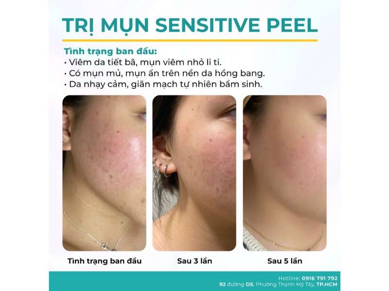 Xông Hơi Trị Mụn: Lợi Ích & Cách Thực Hiện Tại Nhà 21 Địa chỉ nào điều trị mụn uy tín, chất lượng HCM?