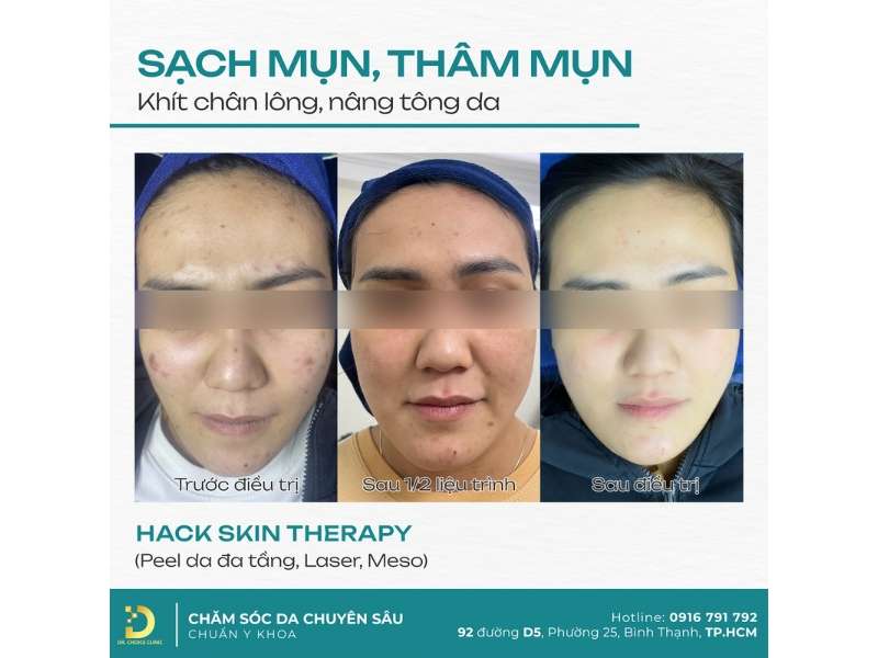 Rối Loạn Sắc Tố Da: Nguyên Nhân, Các Loại & Cách Điều Trị Hiệu Quả 23 Điều trị rối loạn sắc tố da ở đâu uy tín, an toàn tại HCM?
