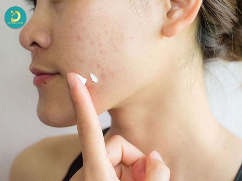 Mụn Ở Tuổi Dậy Thì: Đặc Điểm, Nguyên Nhân Và Cách Điều Trị 19 Điều trị mụn trung bình bằng thuốc bôi theo chỉ định