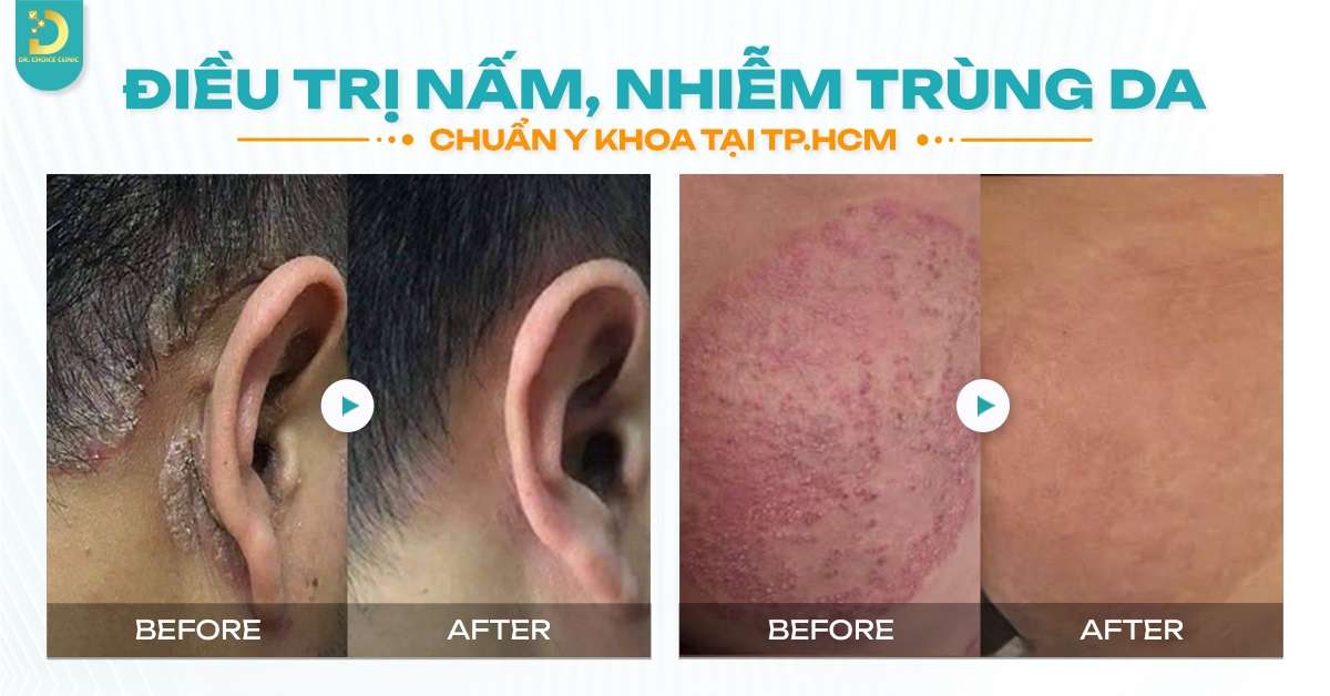 Nấm Da Mặt: Nguyên Nhân, Triệu Chứng & Cách Điều Trị Hiệu Quả 15 Điều trị nấm da mặt ở đâu an toàn, hiệu quả tại HCM?