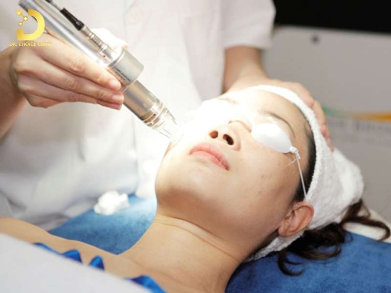 Sẹo Rỗ (Sẹo Lõm): Đặc Điểm, Phân Loại, Nguyên Nhân & Nguyên Tắc Điều Trị 12 Cách trị sẹo rỗ nào hiệu quả ?