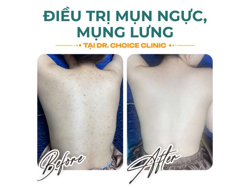 Chế Độ Ăn Cho Người Bị Mụn: Nên Ăn Gì & Kiêng Gì Để Da Nhanh Phục Hồi? 25 Địa chỉ nào thăm khám, điều trị mụn uy tín, chất lượng?