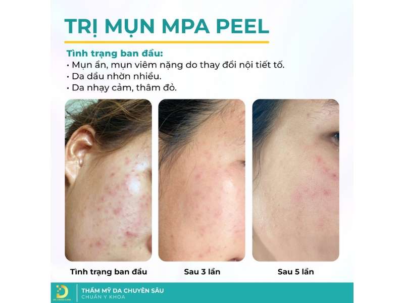 Mụn Ở Tuổi Dậy Thì: Đặc Điểm, Nguyên Nhân Và Cách Điều Trị 20 Các phương pháp điều trị mụn tại clinic hiện nay