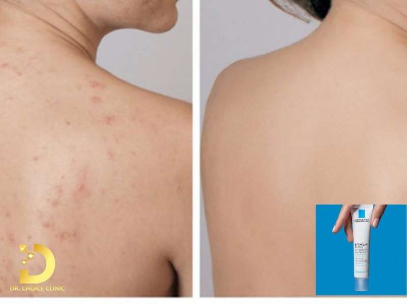 TOP 11 Cách Trị Mụn Lưng Tại Nhà Nhanh, Hiệu Quả 10 Sử dụng thuốc bôi không kê đơn để kiểm soát mụn