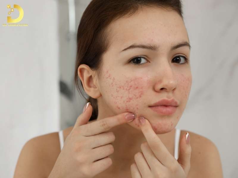 Skincare Cho Da Mụn: Chu Trình Chuẩn & Lưu Ý Sử Dụng Mỹ Phẩm 12 Hiểu đúng về da mụn để skincare không phản tác dụng