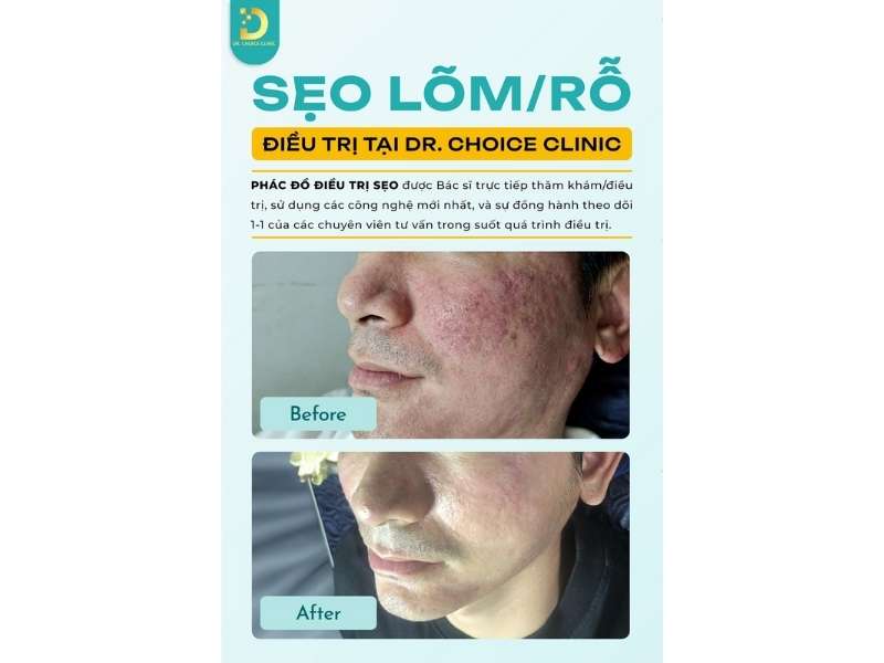 Sẹo Rỗ (Sẹo Lõm): Đặc Điểm, Phân Loại, Nguyên Nhân & Nguyên Tắc Điều Trị 14 Kết quả điều trị sẹo lõm Dr. Choice Clinic.