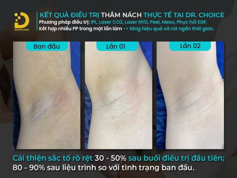 Thâm Nách: Nguyên Nhân Và Cách Điều Trị Hiệu Quả 13 điều trị thâm nách tại Dr. Choice Clinic