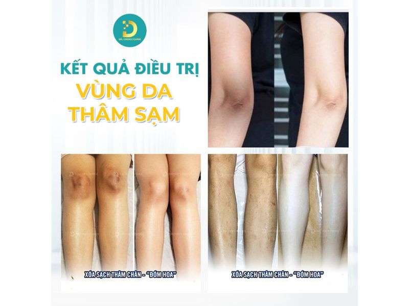 Top Cách Trị Thâm Đầu Gối, Khuỷu Tay, Mắt Cá Hiệu Quả Tại Nhà 21 Kết quả điều trị các vùng da thâm sạm.