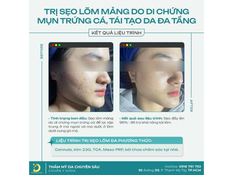 Sẹo Rỗ (Sẹo Lõm): Đặc Điểm, Phân Loại, Nguyên Nhân & Nguyên Tắc Điều Trị 15 Quy trình điều trị sẹo lõm Dr. Choice Clinic