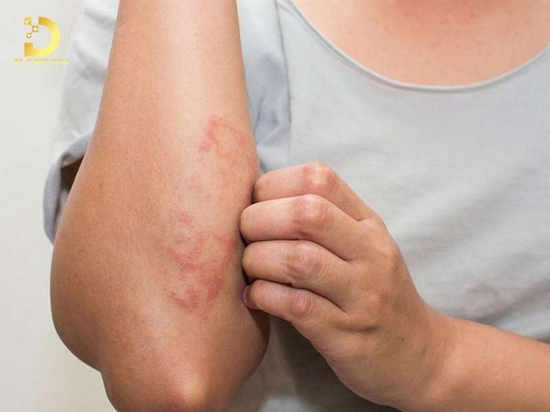 Viêm Da Kích Ứng: Nguyên Nhân, Triệu Chứng, Cách Phòng Ngừa & Điều Trị 10 Làm thế nào để điều trị viêm da kích ứng hiệu quả?