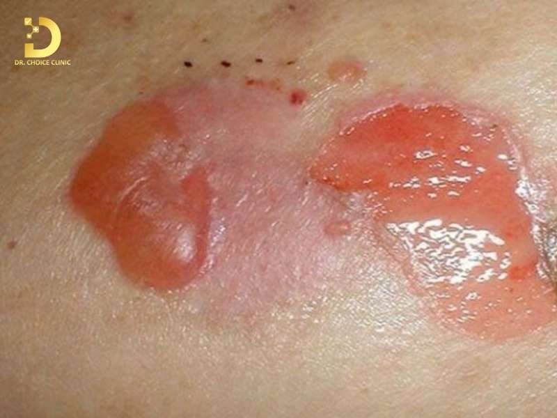 Viêm Da Kích Ứng: Nguyên Nhân, Triệu Chứng, Cách Phòng Ngừa & Điều Trị 12 Viêm da kích ứng có lây từ người sang người không?