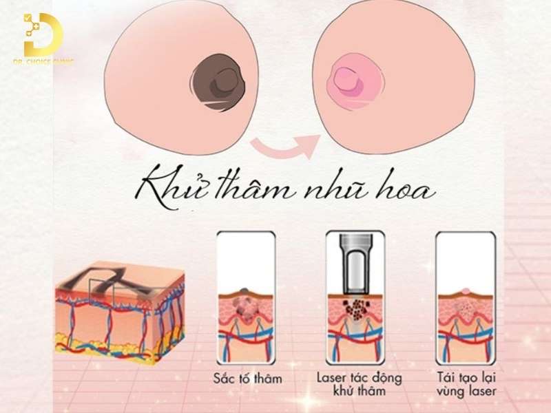 Nhũ Hoa Bị Thâm: Nguyên Nhân & Cách Điều Trị Hiệu Quả 11 Làm thế nào điều trị nhũ hoa bị thâm hiệu quả?