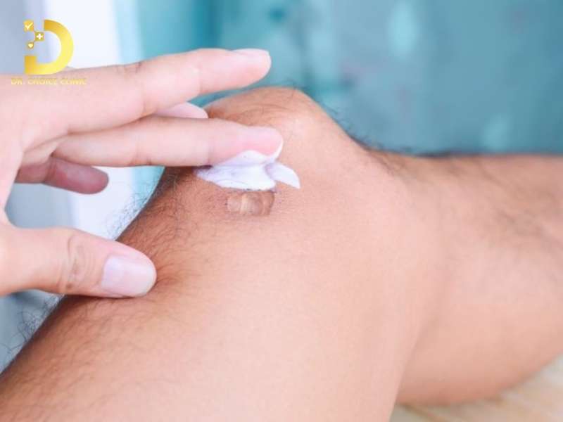 Sẹo Lồi Ở Đầu Gối: Nguyên Nhân & Cách Điều Trị Hiệu Quả 12 Làm thế nào điều trị sẹo lồi ở đầu gối hiệu quả?