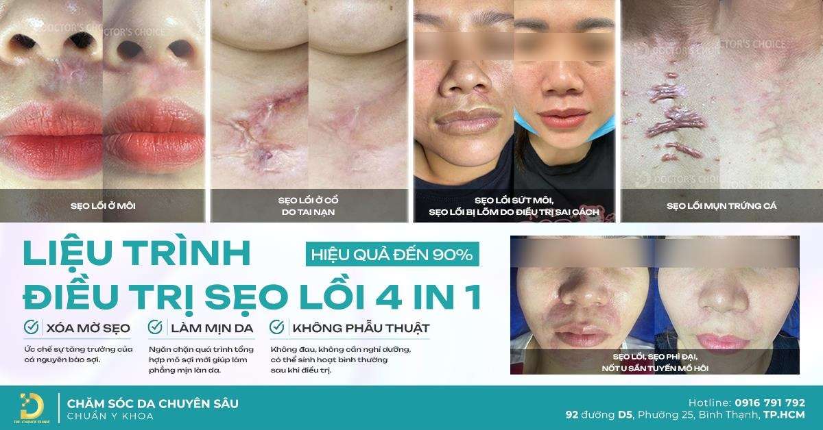 Sẹo Lồi Ở Đầu Gối: Nguyên Nhân & Cách Điều Trị Hiệu Quả 15 Kết quả điều trị sẹo lồi tại Dr. Choice Clinic