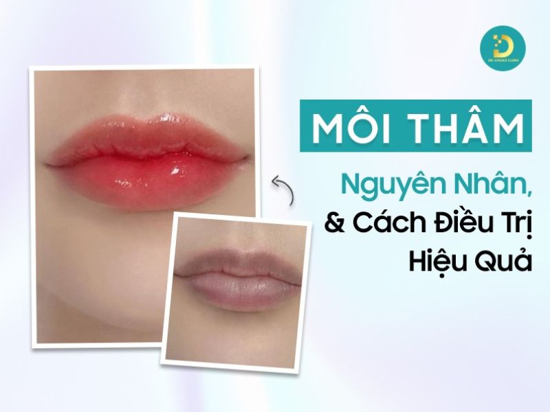 Môi Thâm: Nguyên Nhân & Cách Điều Trị Hiệu Quả 10 Môi thâm: nguyên nhân & cách điều trị hiệu quả