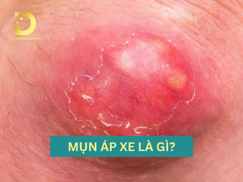 Mụn Áp Xe: Cách Nhận Biết, Nguyên Nhân Và Điều Trị Hiệu Quả 9 Mụn áp xe là gì? làm thế nào để nhận biết chính xác tình trạng này?