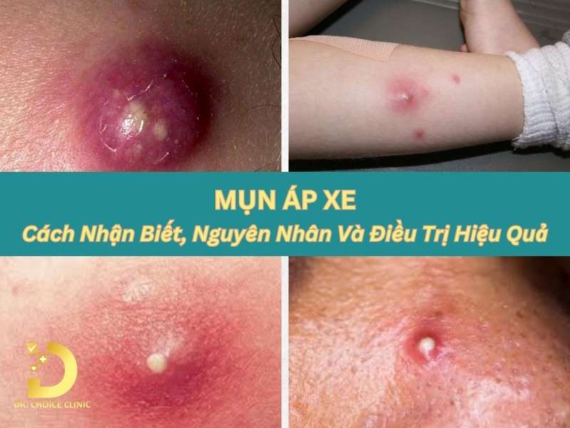 Mụn Áp Xe: Cách Nhận Biết, Nguyên Nhân Và Điều Trị Hiệu Quả 8 Mụn áp xe