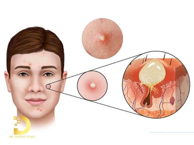 Mụn Bọc Là Gì? Nguyên Nhân, Các Loại Và Cách Điều Trị Hiệu Quả 9 Mụn bọc là gì và làm thế nào để nhận diện mụn bọc chính xác?