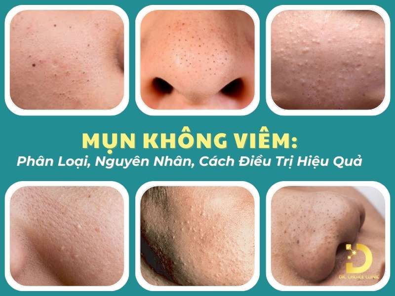 Mụn Không Viêm: Phân Loại, Nguyên Nhân & Cách Điều Trị 9 Mụn không viêm
