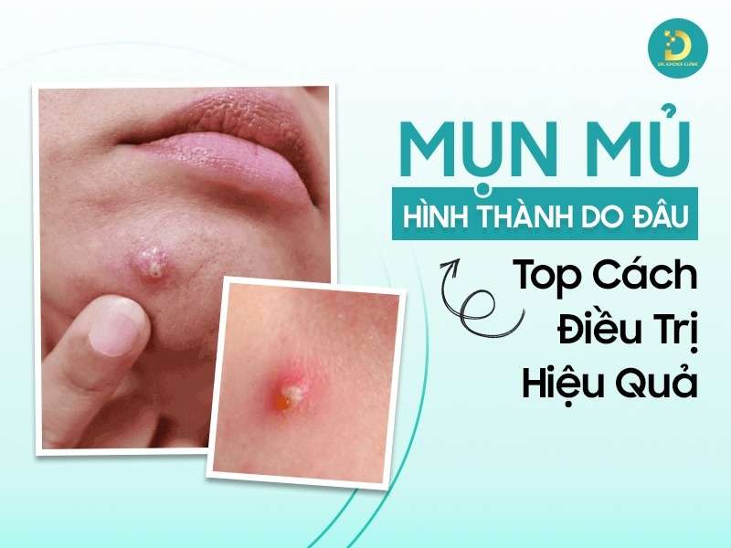 Mụn Mủ Hình Thành Do Đâu? Top Cách Điều Trị Hiệu Quả 12 Mụn mủ hình thành do đâu?