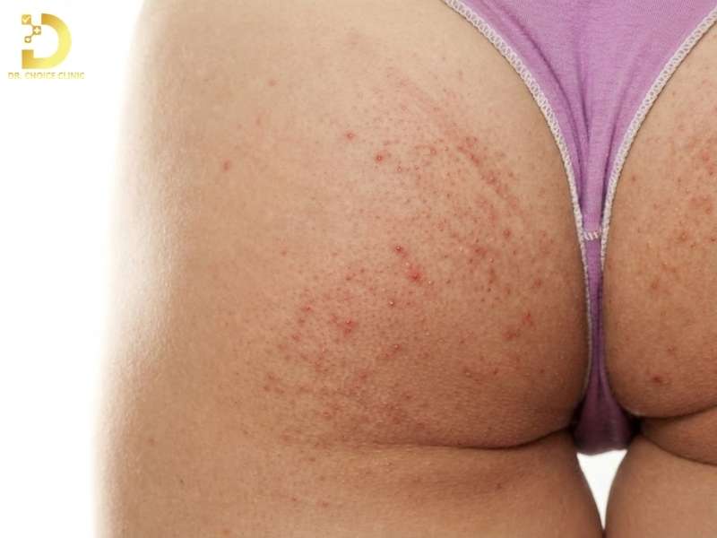 Mụn Ở Mông: Nguyên Nhân & Cách Xử Lý Hiệu Quả Tại Nhà 9 Nội tiết, cơ địa da và yếu tố miễn dịch nền