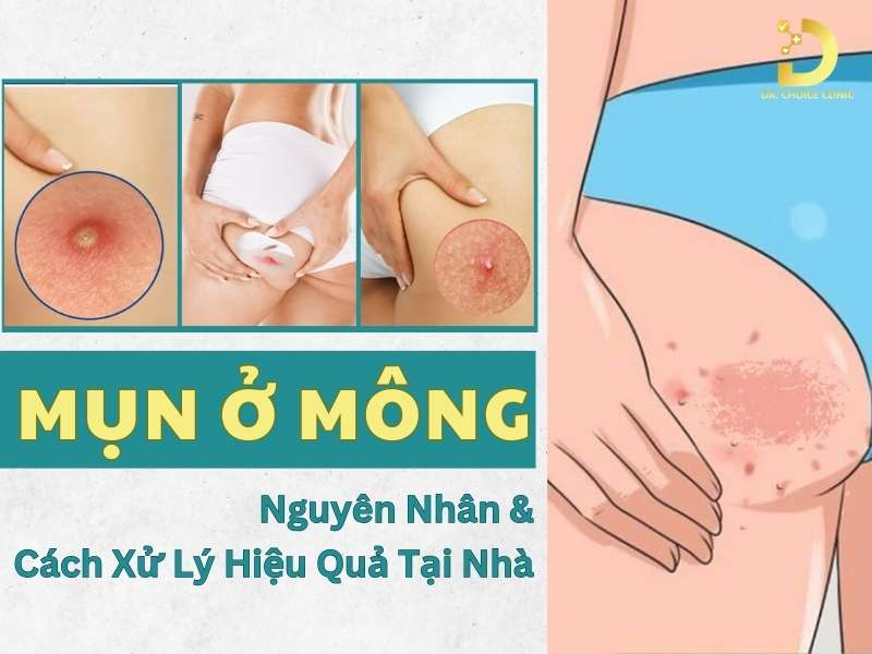 Mụn Ở Mông: Nguyên Nhân & Cách Xử Lý Hiệu Quả Tại Nhà 8 Mụn ở mông
