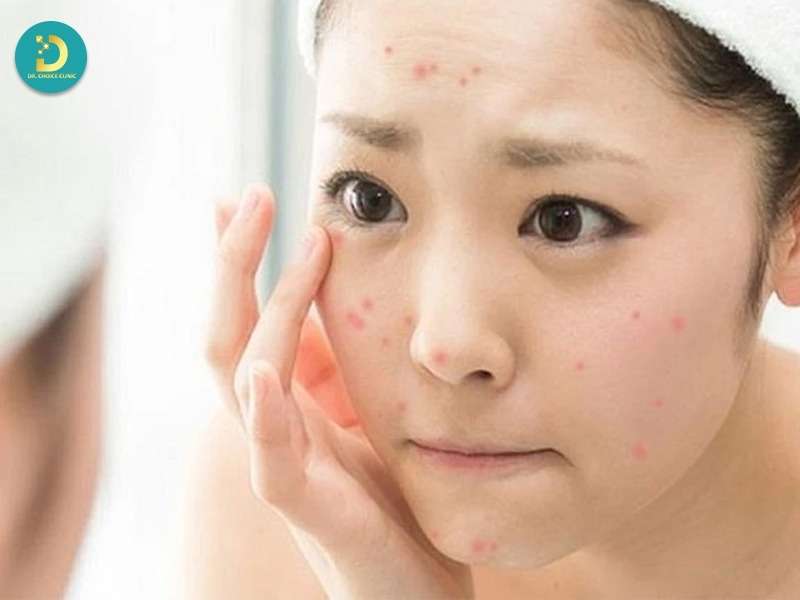 Mụn Ở Tuổi Dậy Thì: Đặc Điểm, Nguyên Nhân Và Cách Điều Trị 13 Mụn ở tuổi dậy thì là gì?