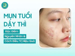 Mụn ở tuổi dậy thì