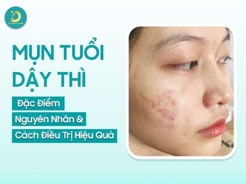 Mụn Ở Tuổi Dậy Thì: Đặc Điểm, Nguyên Nhân Và Cách Điều Trị 12 Mụn ở tuổi dậy thì