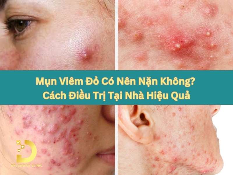 Mụn Viêm Đỏ Có Nên Nặn Không? Cách Điều Trị Tại Nhà Hiệu Quả 9 Mụn viêm đỏ có nên nặn không?