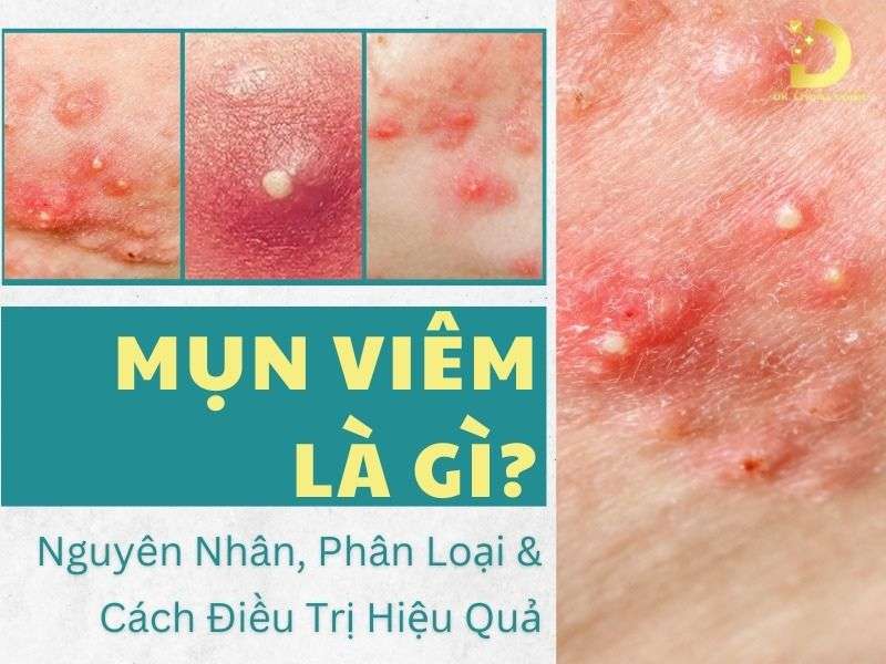 Mụn Viêm Là Gì? Nguyên Nhân, Phân Loại & Cách Điều Trị Hiệu Quả 10 Mụn viêm là gì?