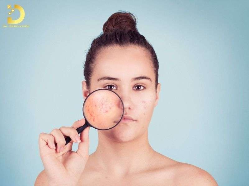 Mụn Viêm Là Gì? Nguyên Nhân, Phân Loại & Cách Điều Trị Hiệu Quả 11 Mụn viêm là gì? vì sao đây là giai đoạn nguy hiểm nhất của mụn?