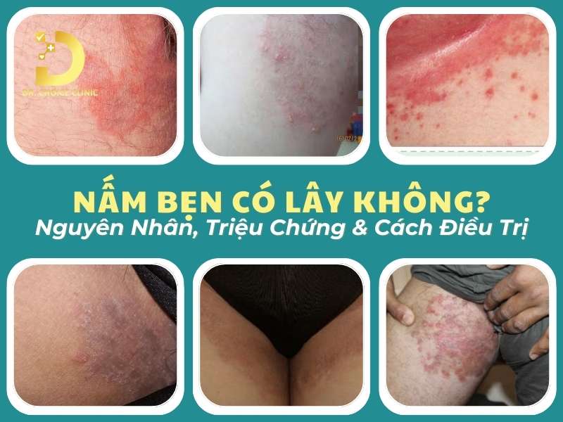 Nấm Bẹn Có Lây Không? Nguyên Nhân, Triệu Chứng & Cách Điều Trị 8 Nấm bẹn có lây không?