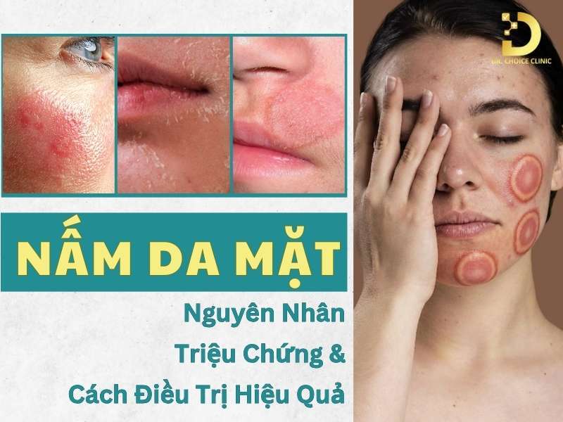 Nấm Da Mặt: Nguyên Nhân, Triệu Chứng & Cách Điều Trị Hiệu Quả 9 Nấm da mặt