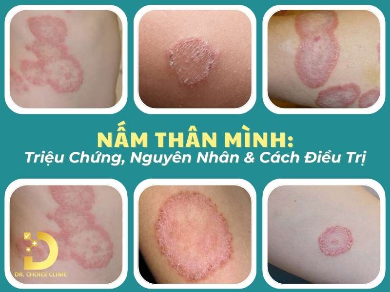Nấm Thân Mình: Triệu Chứng, Nguyên Nhân & Cách Điều Trị Hiệu Quả 9 Nấm thân mình