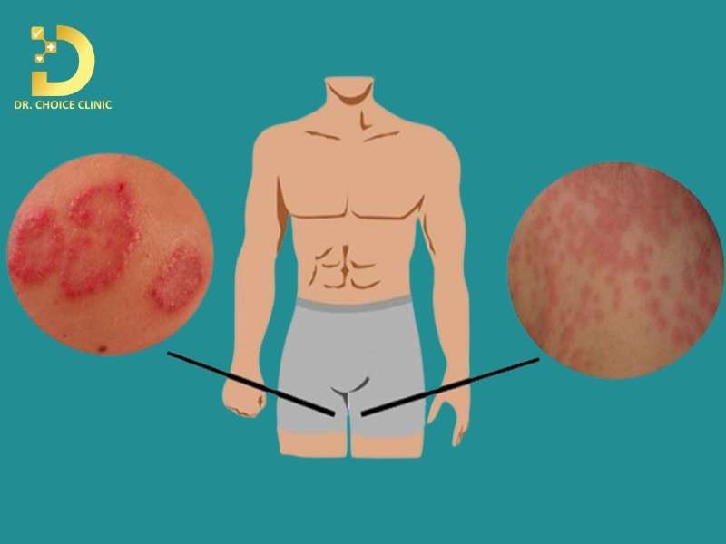 Nấm Bẹn Có Lây Không? Nguyên Nhân, Triệu Chứng & Cách Điều Trị 9 Nấm vùng bẹn là gì? có lây nhiễm không?