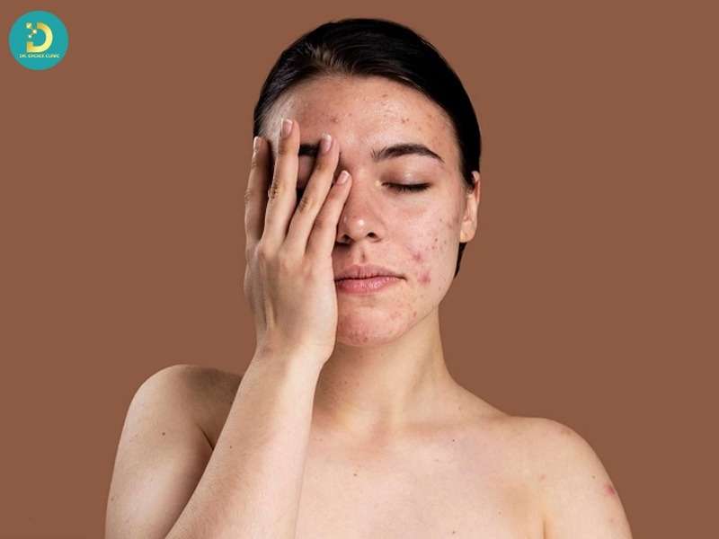 Mụn Mủ Hình Thành Do Đâu? Top Cách Điều Trị Hiệu Quả 14 Nguyên nhân bên trong cơ thể
