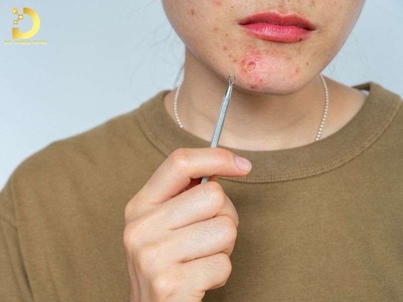 Mụn Viêm Là Gì? Nguyên Nhân, Phân Loại & Cách Điều Trị Hiệu Quả 12 Nguyên nhân gây mụn viêm