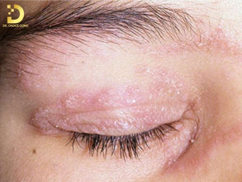 Nấm Da Mặt: Nguyên Nhân, Triệu Chứng & Cách Điều Trị Hiệu Quả 10 Nguyên nhân hình thành nấm da mặt