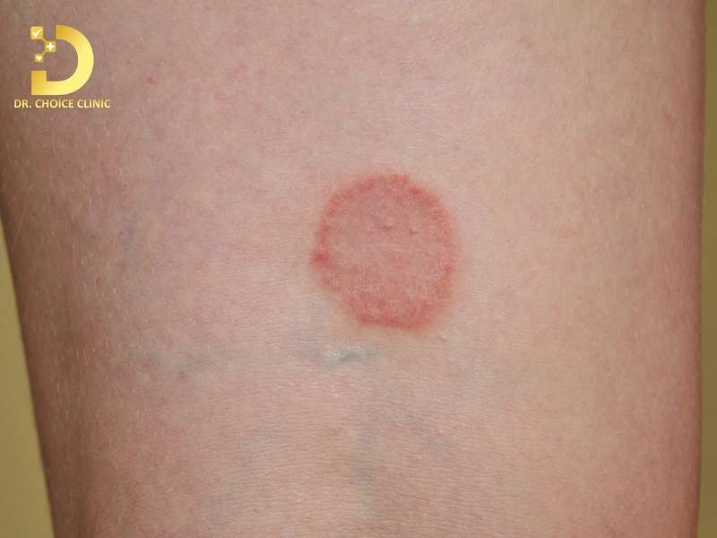 Nấm Thân Mình: Triệu Chứng, Nguyên Nhân & Cách Điều Trị Hiệu Quả 11 Nguyên nhân nào dẫn đến tình trạng nhiễm nấm thân mình?