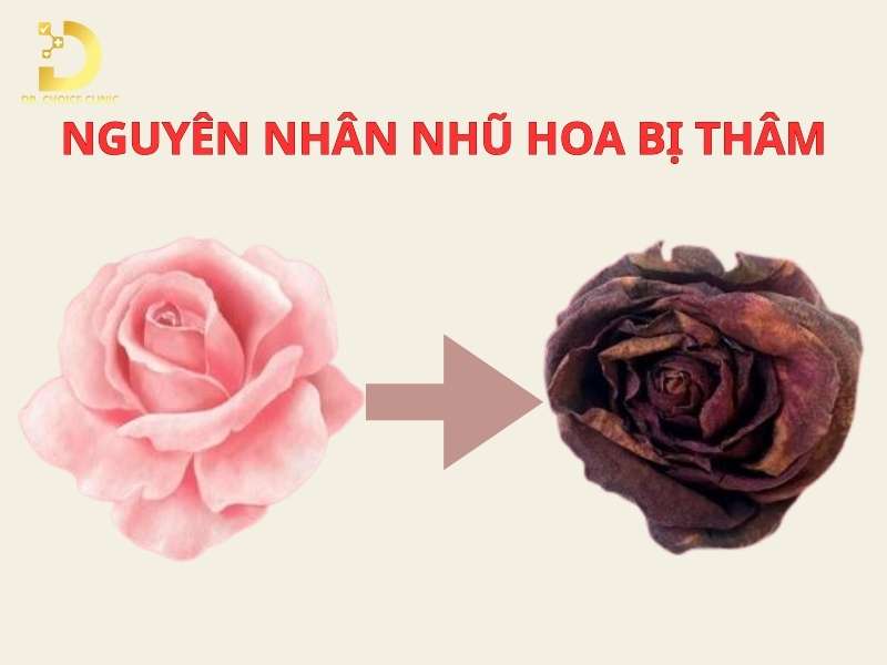 Nhũ Hoa Bị Thâm: Nguyên Nhân & Cách Điều Trị Hiệu Quả 10 Nguyên nhân nào khiến nhũ hoa bị thâm?