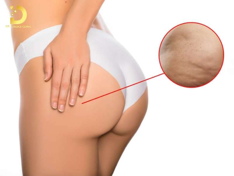 Thâm Mông: Nguyên Nhân & Cách Điều Trị Hiệu Quả 10 Nguyên nhân sinh lý và thói quen nào dẫn đến tình trạng thâm sạm vùng mông?