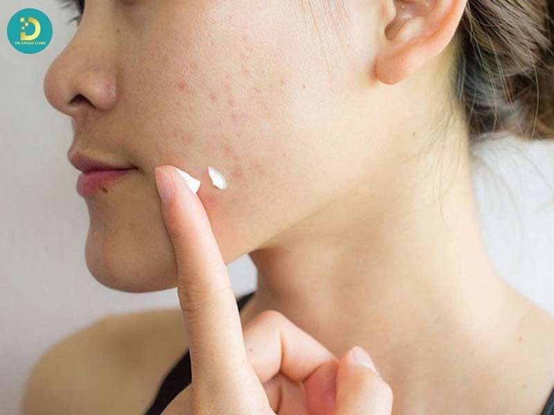 Mụn Mủ Hình Thành Do Đâu? Top Cách Điều Trị Hiệu Quả 17 Nhóm trị mụn nội khoa
