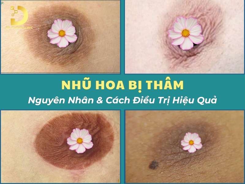 Nhũ Hoa Bị Thâm: Nguyên Nhân & Cách Điều Trị Hiệu Quả 8 Nhũ hoa bị thâm