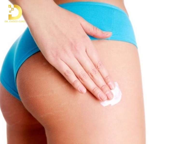 Thâm Mông: Nguyên Nhân & Cách Điều Trị Hiệu Quả 12 Những sai lầm phổ biến nào khiến việc điều trị thâm mông mãi không có kết quả?