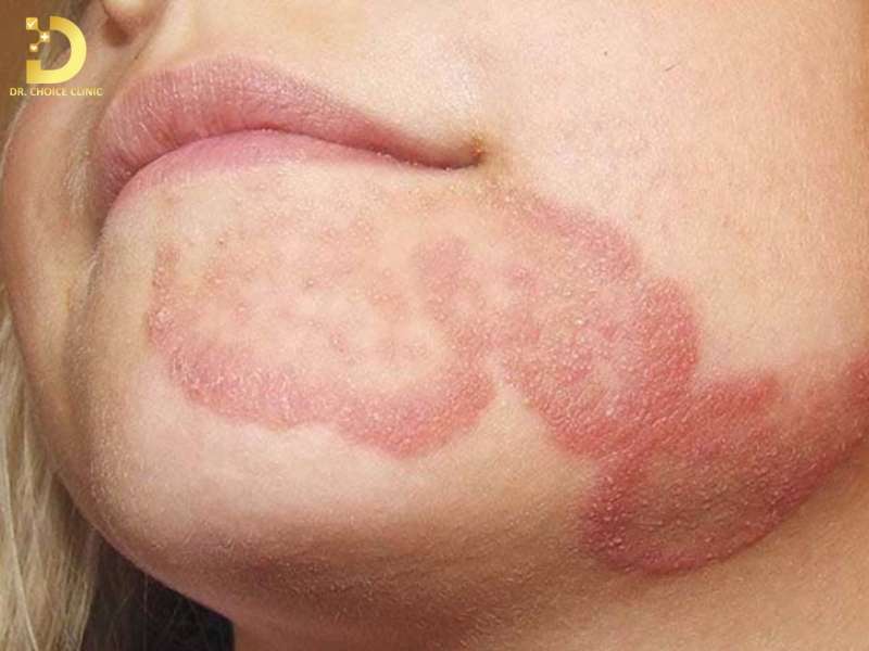 Nấm Da Mặt: Nguyên Nhân, Triệu Chứng & Cách Điều Trị Hiệu Quả 14 Những sai lầm thường gặp khi điều trị nấm da mặt
