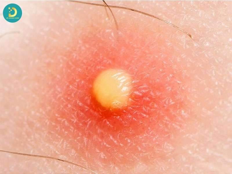 Mụn Mủ Hình Thành Do Đâu? Top Cách Điều Trị Hiệu Quả 13 Phân loại mụn mủ