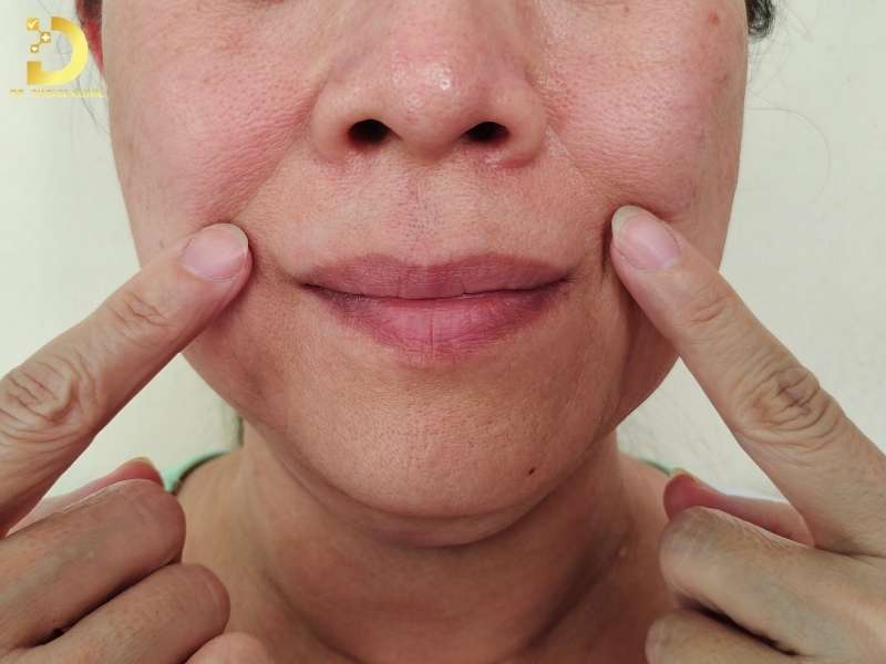 Rãnh Cười Là Gì? Nguyên Nhân & Cách Làm Đầy Hiệu Quả 10 Phân loại rãnh cười như thế nào theo độ sâu?