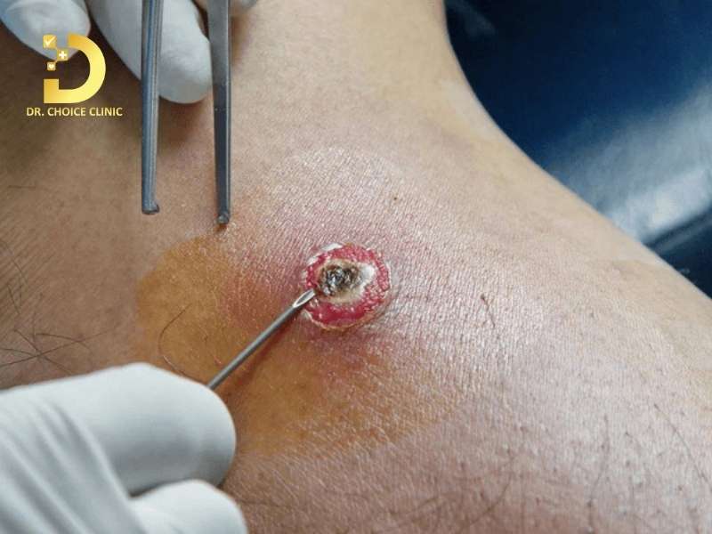 Mụn Áp Xe: Cách Nhận Biết, Nguyên Nhân Và Điều Trị Hiệu Quả 11 Phương pháp điều trị mụn áp xe nào mang lại hiệu quả cao và an toàn nhất?